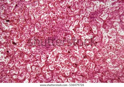 Human Liver Cells Cancer Under Microscope Stock Photo (Edit Now) 536479726