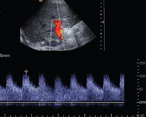 Normal main hepatic arterial waveform. Doppler image of the main hepatic artery post liver ...