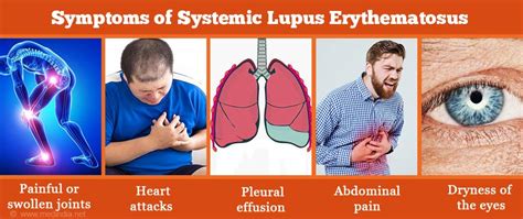 Systemic Lupus