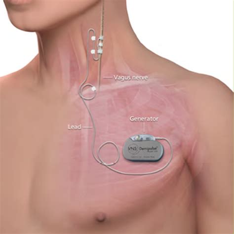 Vagus nerve stimulation implant praised by depression patient - BBC News