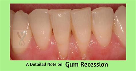 A Detailed Note on Gum Recession - Expert Dental Care