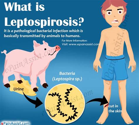 Leptospirosis|Causes|Symptoms|Treatment