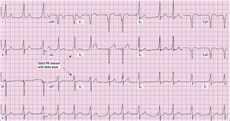 Sinus Ventricular Tachycardia