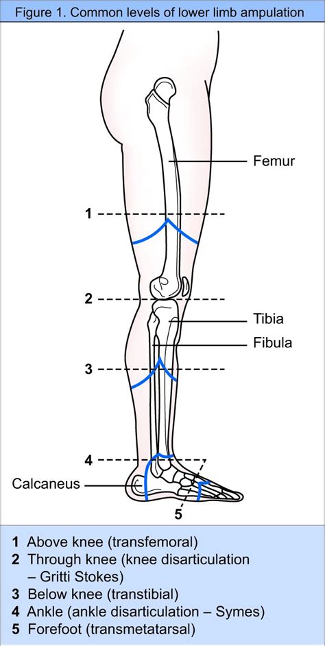 Wound healing complications associated with lower limb amputation