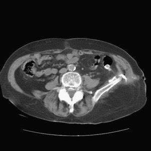 CT scan showing the colocutaneous fistula in the left flank area. | Download Scientific Diagram