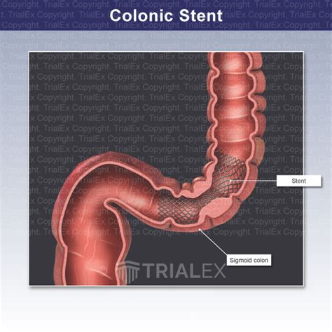 Colonic Stent - TrialQuest Inc.