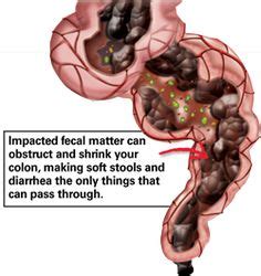 Soft Stool, Colonic Hydrotherapy, Impaction, Bowel Movement, Nutrient ...