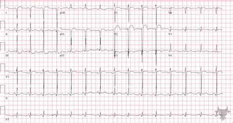 Left Ventricular Aneurysm | ECG Stampede