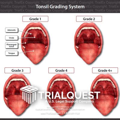 Tonsil Grading System - TrialExhibits Inc.