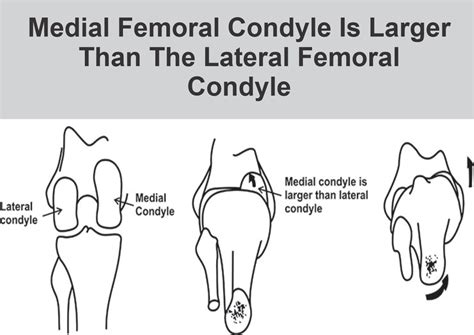 Medial Femoral Condyle Is Larger Than The Lateral Femoral Condyle ...