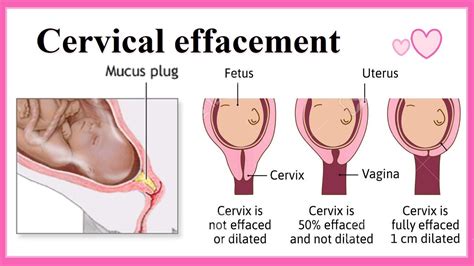 cervical effacement - YouTube