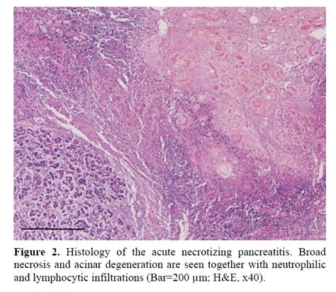 Cytomegalovirus-Associated Severe Fatal Necrotizing Pancreatitis