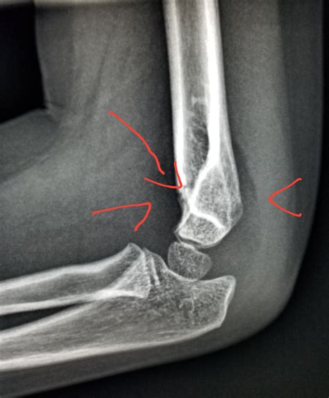 #Elbow #Xray shows #fracture (arrow: #suprachondylar) with a #joint #effusion (arrowhead) in a # ...