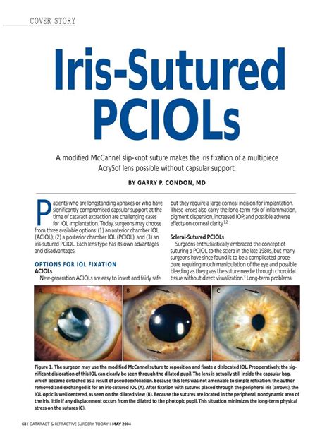 Iris-Sutured PCIOLs - Cataract & Refractive Surgery Today