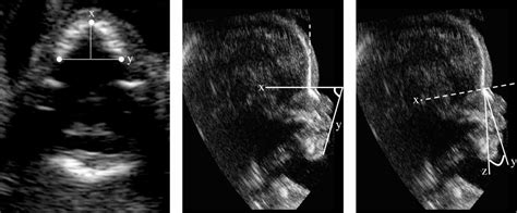 Maxilla And Mandible Fetal Ultrasound