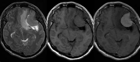 Dr Balaji Anvekar FRCR: Sphenoid wing Meningioma MRI