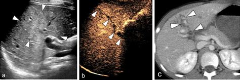 Liver laceration in an 8-year-old boy with a bicycle handlebar injury.... | Download Scientific ...