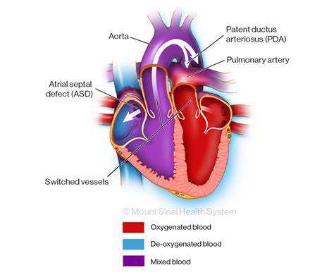 Transposition of the Great Arteries Diagnosis & Treatments | Mount Sinai - New York