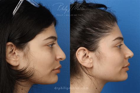 Indian Rhinoplasty New York City, New York | Dr. Philip Miller