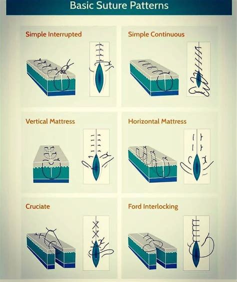 Surgical Sutures And Suturing Techniques - vrogue.co