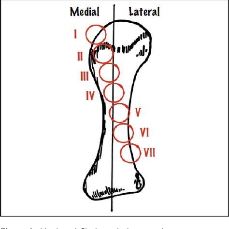 Table 2 from Tibial Sesamoid Position Influence on Functional Outcome and Satisfaction After ...