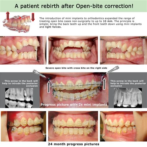 Open Bite Treatment | iSmile Specialists