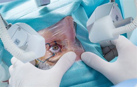 Laser Surgery for Cataracts: Prep, Recovery, Long-Term Care