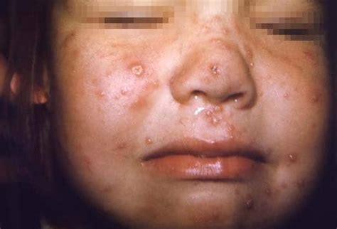 Varicella-Zoster Virus (VZV): Slideshow