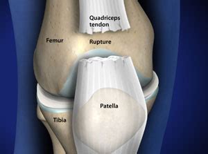 Omaha Quadriceps Tendon Rupture | Quadriceps Tendon Tear