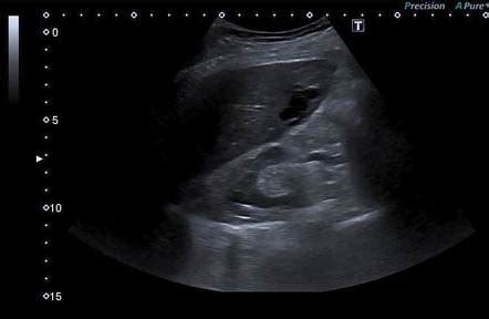 Congenital portosystemic shunt | Radiology Case | Radiopaedia.org