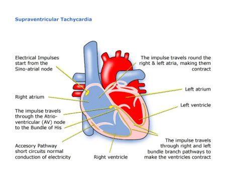 Palpitations | Supraventricular tachycardia (SVT) - Child Heart Specialist