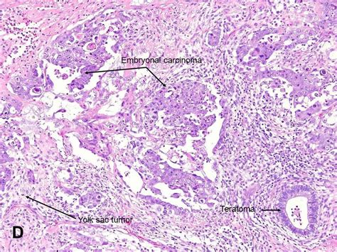 American Urological Association - Mixed Germ Cell Tumor