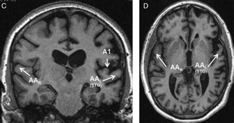 MRI links brain region to dementia, auditory deterioration