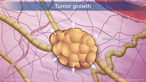 Understanding Soft Tissue Sarcoma