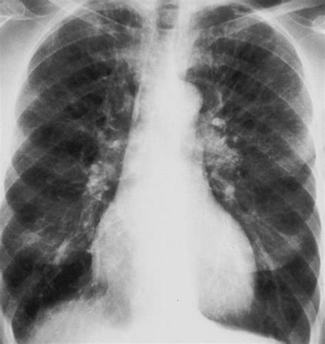 Chronic Obstructive Pulmonary Disease (COPD) - Pulmonary Disorders ...