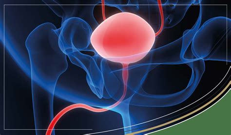 Radiation Cystitis | Symptoms & Prevention – SC Nutra International