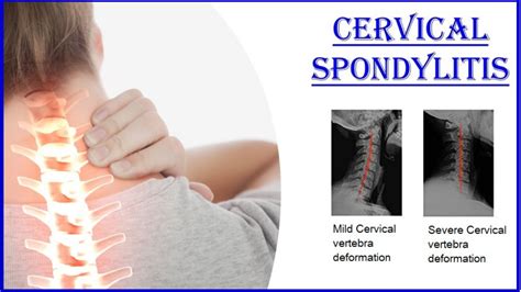 Cervical Spondylosis What Is Cervical Spondylosis And Symptoms | SexiezPix Web Porn