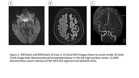 Hemichorea secondary to Middle Cerebral Artery (MCA) Stenosis without evidence of ischemic ...