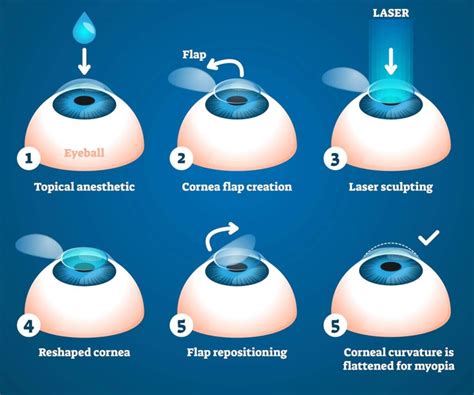 LASIK Waltham | LASIK Wellesley | Putnoi Eye Care