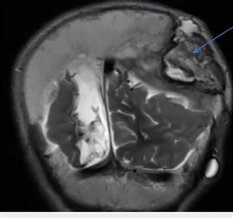 Figure 2 from Epidural Abscess Following Epidural Evacuation in a Patient With ...