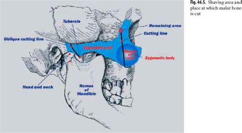 Malar Bone Reduction - Aesthetic Surgery - AmeriCorps Health