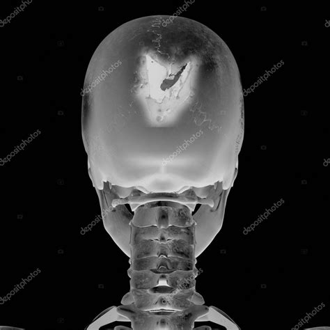 3D Radiograph with head injury Stock Photo by ©Digitalstudio 3057071