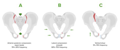 Pelvic Fractures | Concise Medical Knowledge