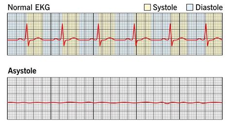 Asystole – definition, symptoms, causes, management – Healthy Food Near Me