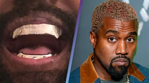 Kanye West’s $850,000 titanium teeth are ‘permanent’ and go ‘beyond ...