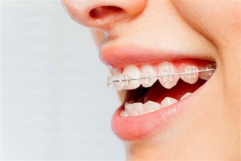 Self-Ligating Braces Cost and Benefits