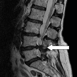 Lumbar Spondylosis And Physiotherapy Treatment, Exercise