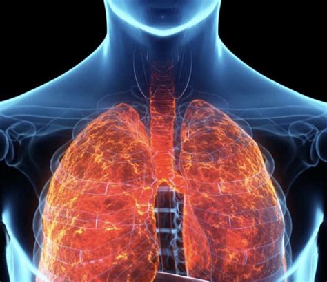 Acute Respiratory Failure: What Is Acute Respiratory Failure?