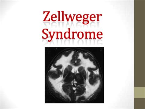 Zellweger syndrome