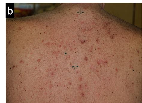 Cureus | Secondary Cutaneous Involvement in Follicular Diffuse Lymphoma Treated with Helical ...